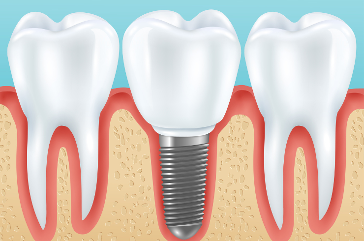 Dental Implants